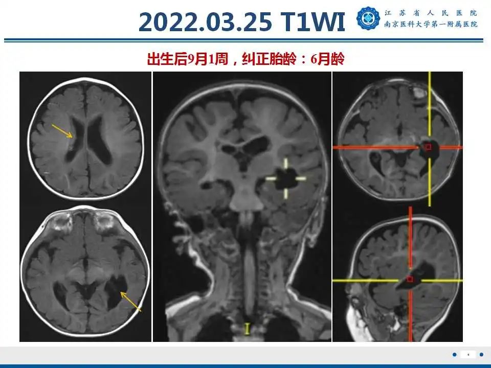 【PPT】生发基质-脑室内出血-5