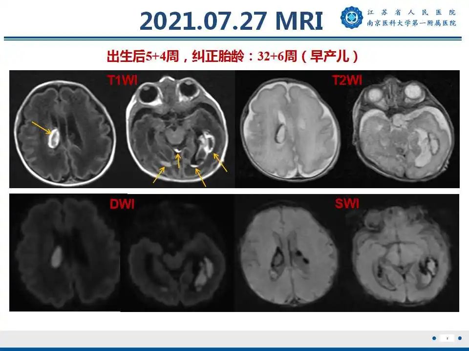 【PPT】生发基质-脑室内出血-3