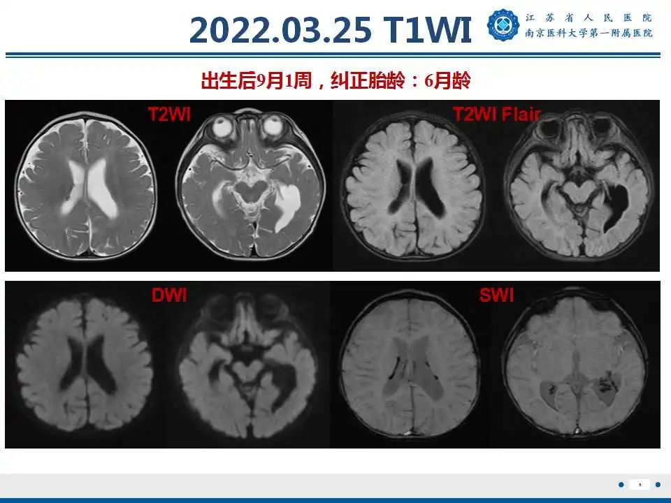【PPT】生发基质-脑室内出血-6