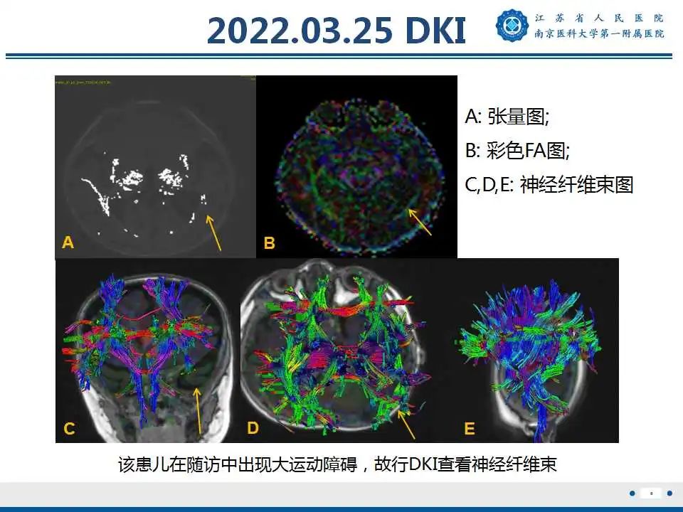 【PPT】生发基质-脑室内出血-7