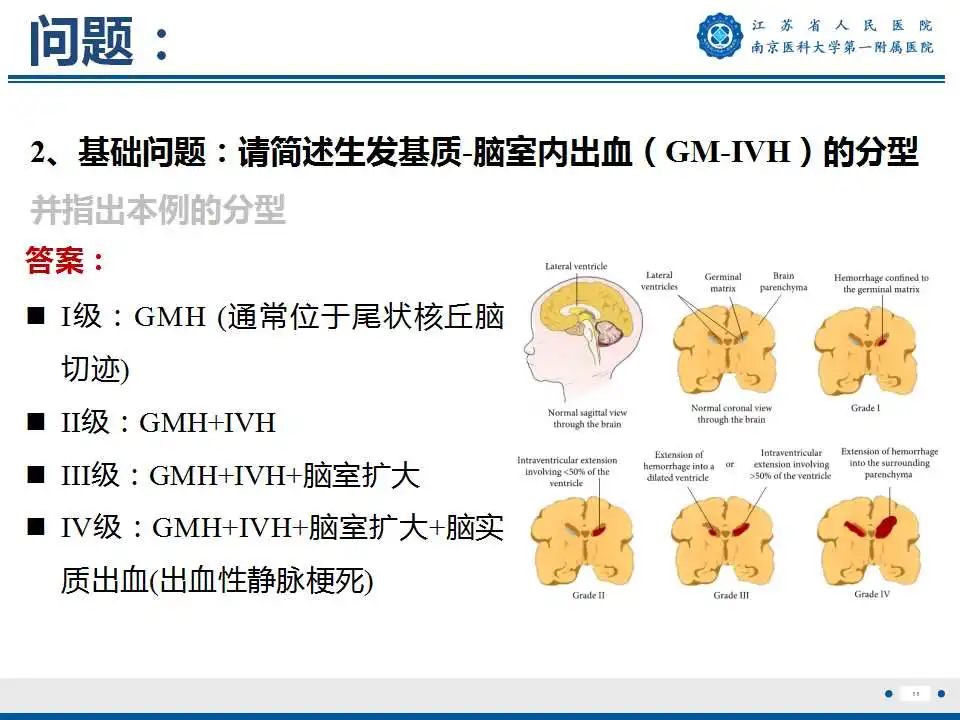 【PPT】生发基质-脑室内出血-12