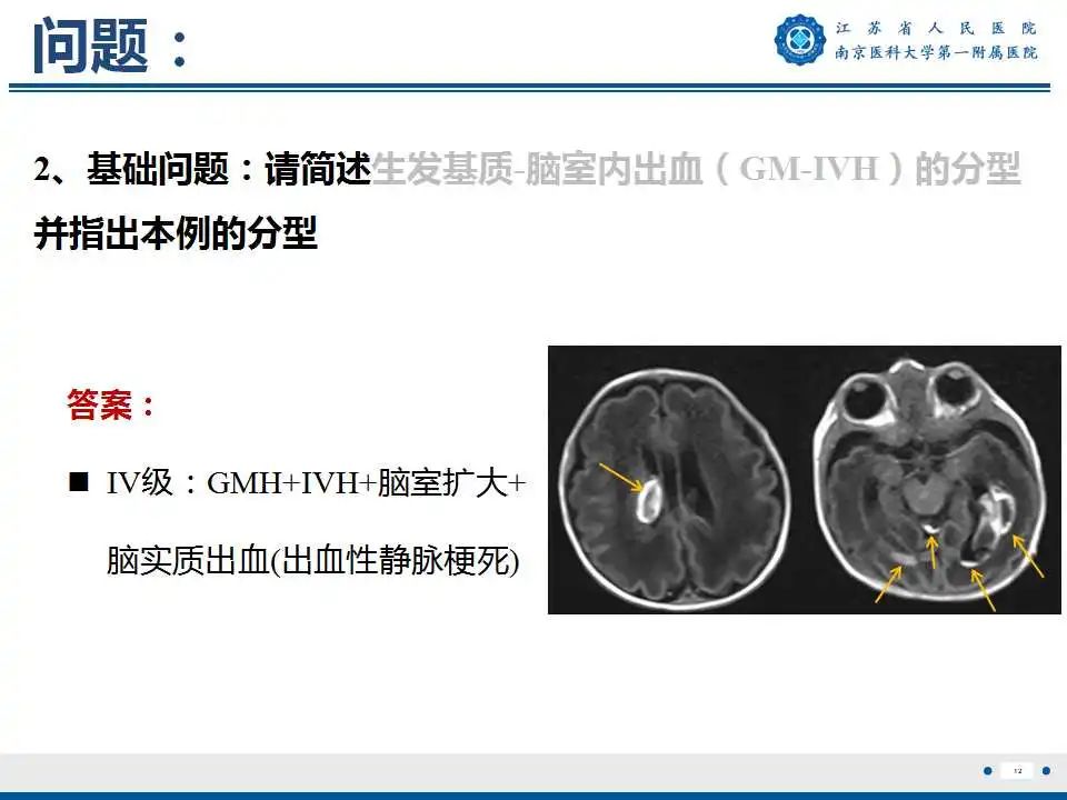 【PPT】生发基质-脑室内出血-13