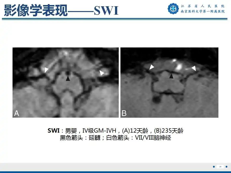【PPT】生发基质-脑室内出血-25