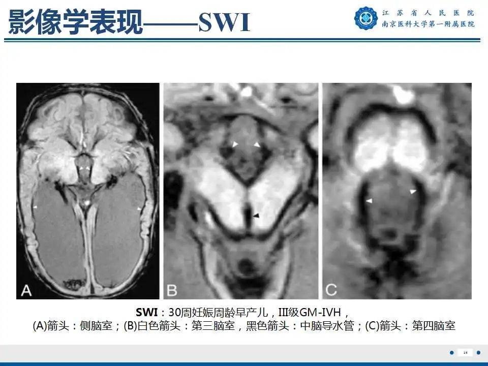 【PPT】生发基质-脑室内出血-26
