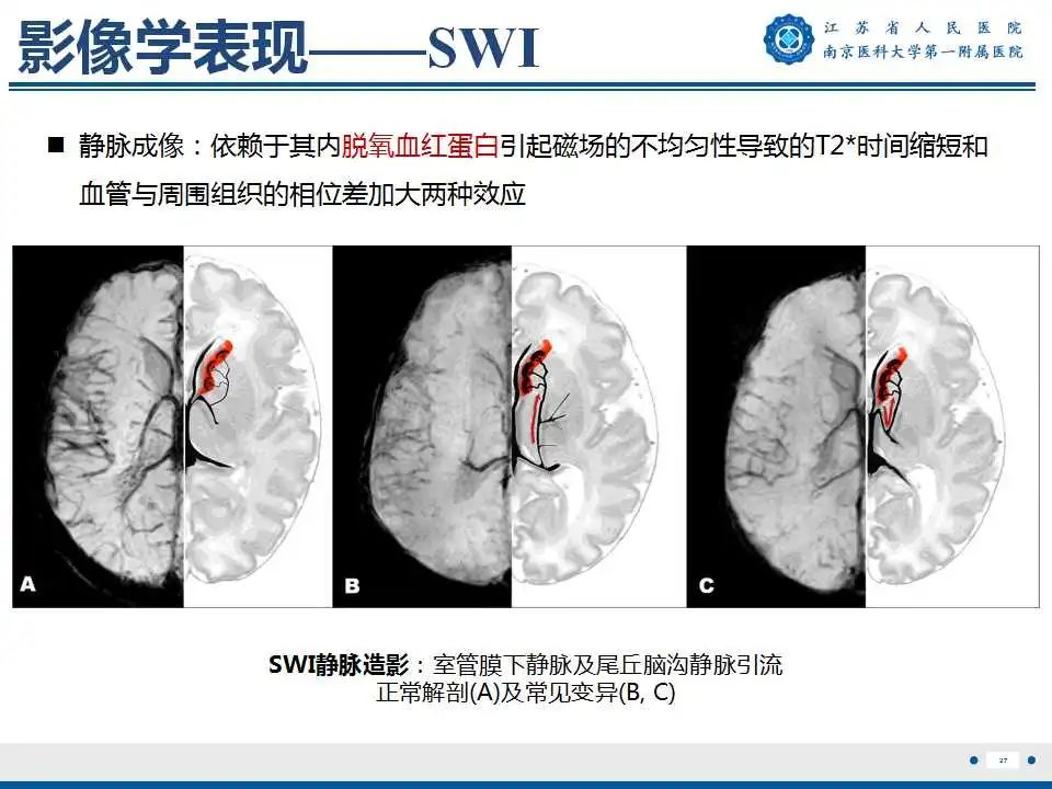 【PPT】生发基质-脑室内出血-28