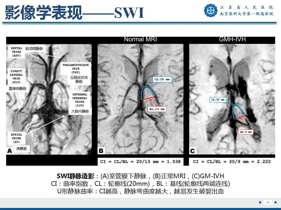 【PPT】生发基质-脑室内出血-29