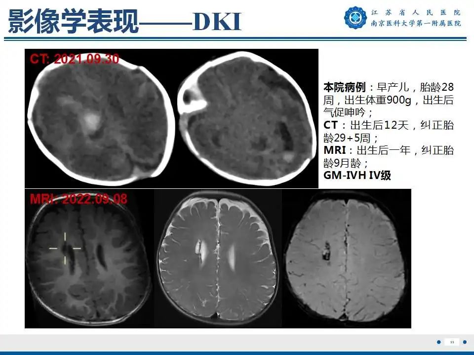 【PPT】生发基质-脑室内出血-34