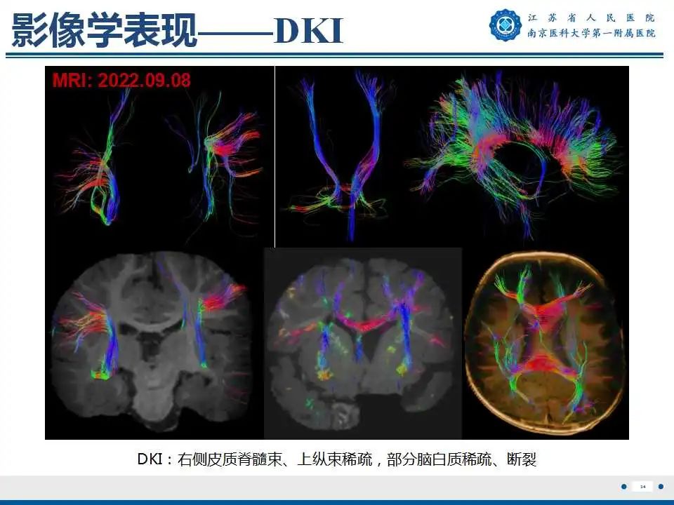 【PPT】生发基质-脑室内出血-35