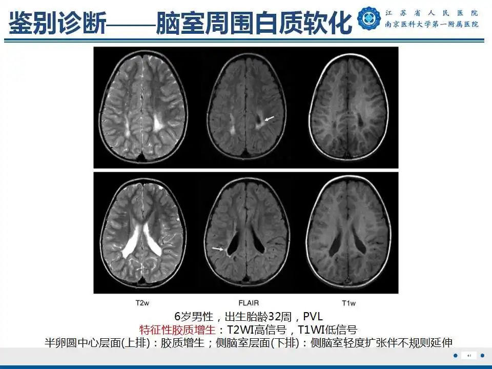 【PPT】生发基质-脑室内出血-42
