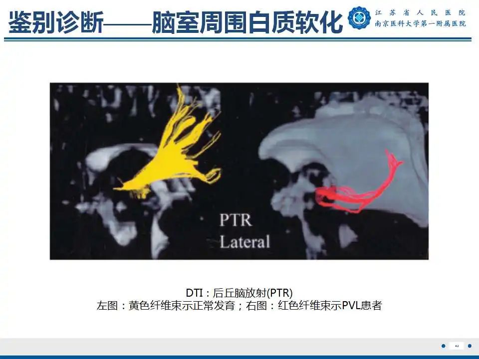 【PPT】生发基质-脑室内出血-43