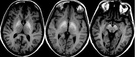 【病例】肝性脑病1例MR影像表现-5