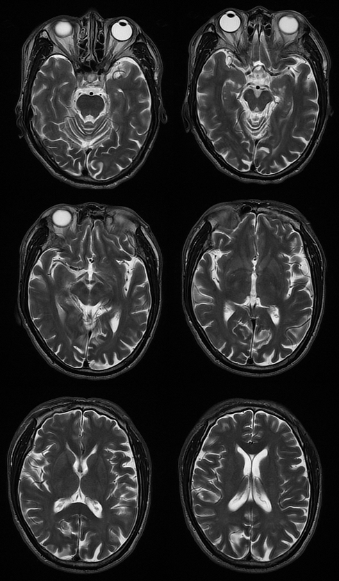 【病例】肝性脑病1例MR影像表现-2