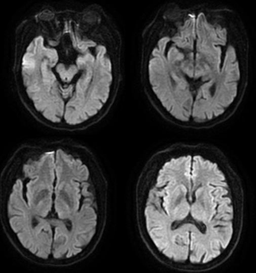 【病例】肝性脑病1例MR影像表现-4