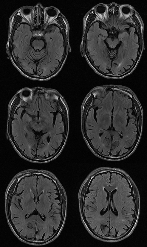【病例】肝性脑病1例MR影像表现-3