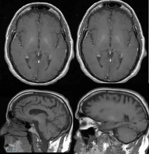 【病例】肝性脑病1例MR影像表现-6