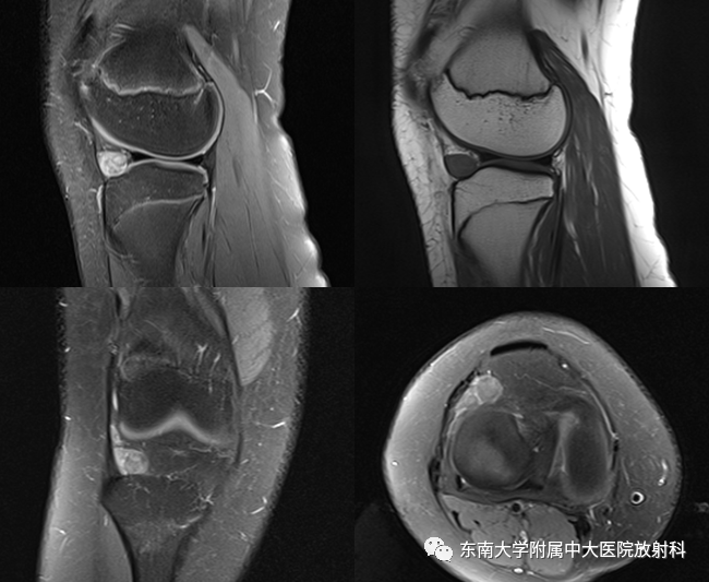 膝关节腱鞘巨细胞瘤