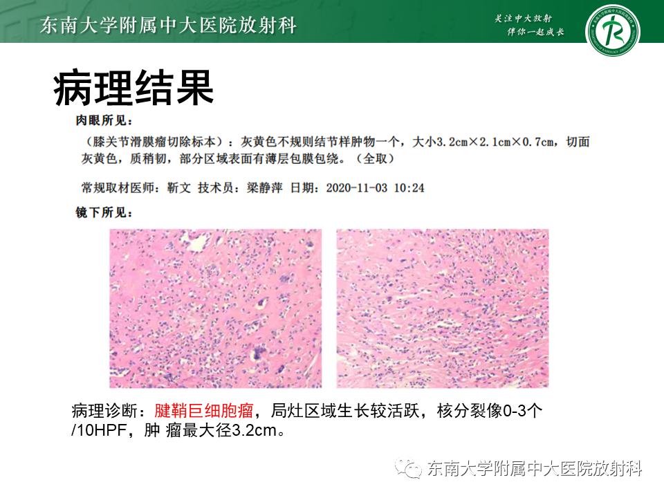 【PPT】膝关节腱鞘巨细胞瘤-3 【PPT】膝关节腱鞘巨细胞瘤-3