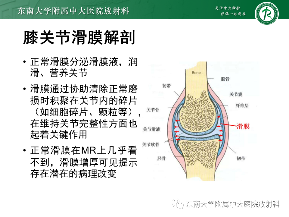 【PPT】膝关节腱鞘巨细胞瘤-7 【PPT】膝关节腱鞘巨细胞瘤-7