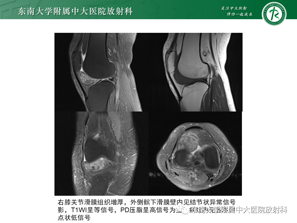 【PPT】膝关节腱鞘巨细胞瘤-13 【PPT】膝关节腱鞘巨细胞瘤-13