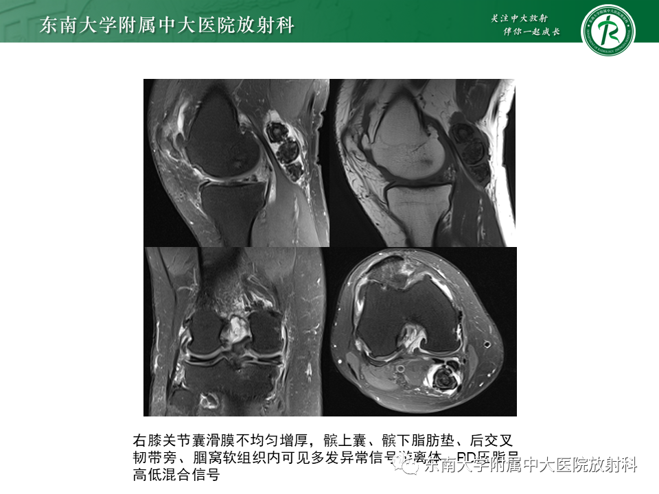 【PPT】膝关节腱鞘巨细胞瘤-21 【PPT】膝关节腱鞘巨细胞瘤-21