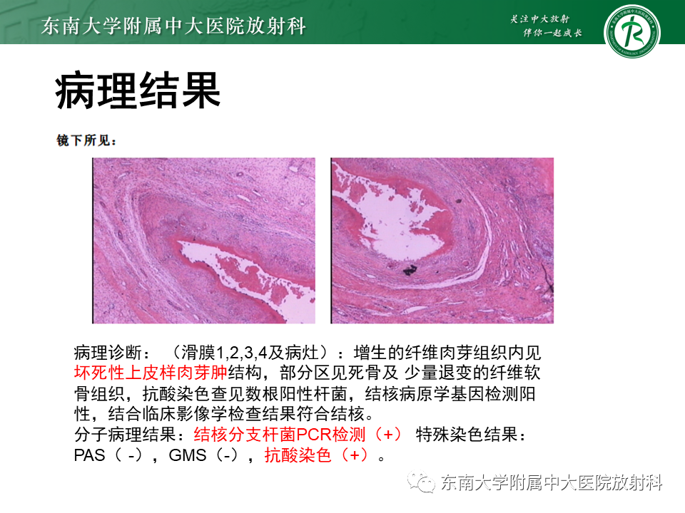 【PPT】膝关节腱鞘巨细胞瘤-27 【PPT】膝关节腱鞘巨细胞瘤-27