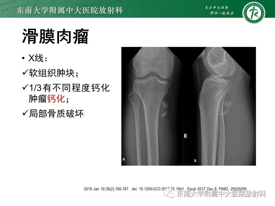【PPT】膝关节腱鞘巨细胞瘤-29 【PPT】膝关节腱鞘巨细胞瘤-29