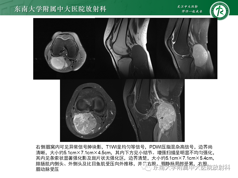 【PPT】膝关节腱鞘巨细胞瘤-33 【PPT】膝关节腱鞘巨细胞瘤-33