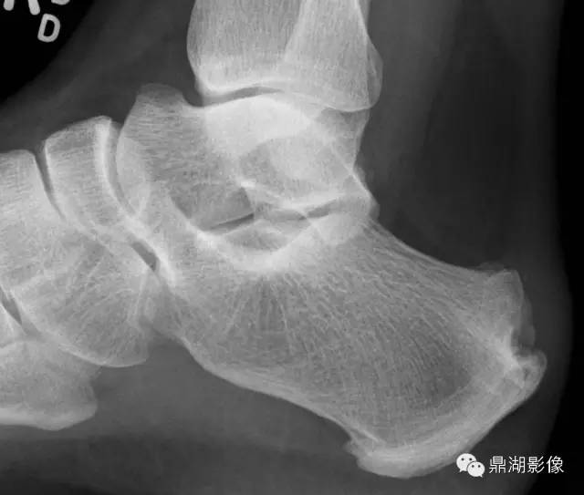 跟骨的“食蚁兽鼻征”-2