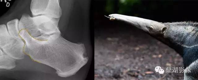跟骨的“食蚁兽鼻征”-1