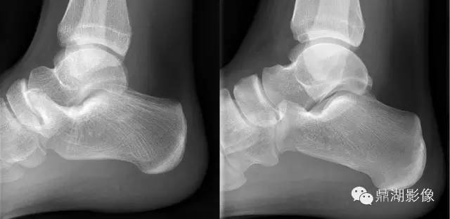 跟骨的“食蚁兽鼻征”-3