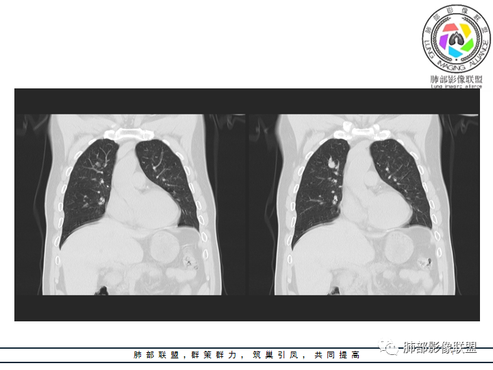 【病例】诡异的肺结节！-6