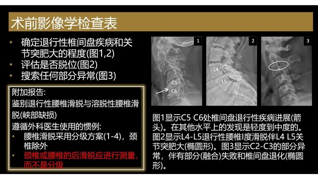 【PPT】评估围手术期脊柱:除了退行性椎间盘疾病和金属植入物的并发症外-7 【PPT】评估围手术期脊柱:除了退行性椎间盘疾病和金属植入物的并发症外-7