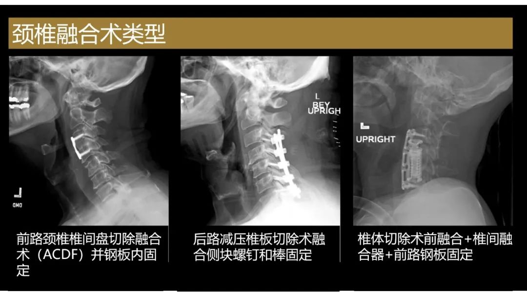 【PPT】评估围手术期脊柱:除了退行性椎间盘疾病和金属植入物的并发症外-11 【PPT】评估围手术期脊柱:除了退行性椎间盘疾病和金属植入物的并发症外-11