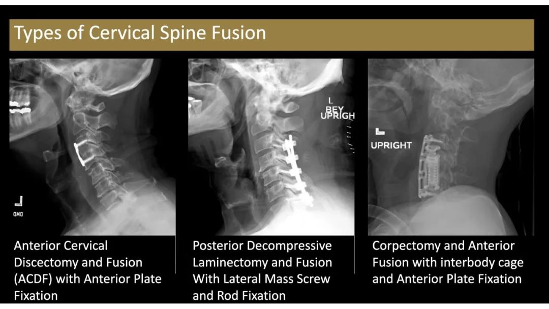 【PPT】评估围手术期脊柱:除了退行性椎间盘疾病和金属植入物的并发症外-12 【PPT】评估围手术期脊柱:除了退行性椎间盘疾病和金属植入物的并发症外-12