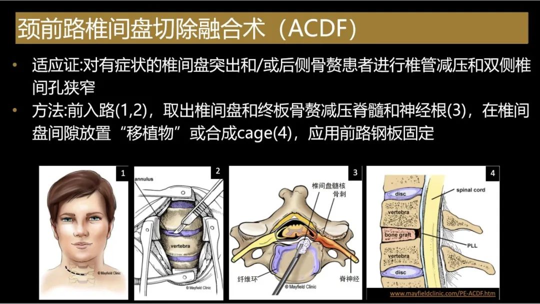 【PPT】评估围手术期脊柱:除了退行性椎间盘疾病和金属植入物的并发症外-13 【PPT】评估围手术期脊柱:除了退行性椎间盘疾病和金属植入物的并发症外-13