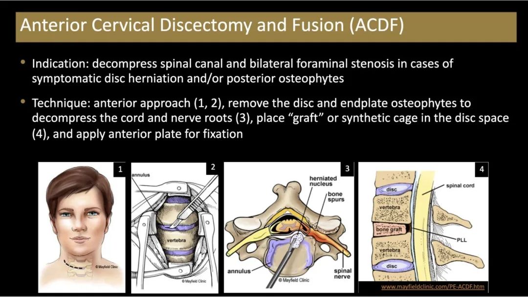 【PPT】评估围手术期脊柱:除了退行性椎间盘疾病和金属植入物的并发症外-14 【PPT】评估围手术期脊柱:除了退行性椎间盘疾病和金属植入物的并发症外-14