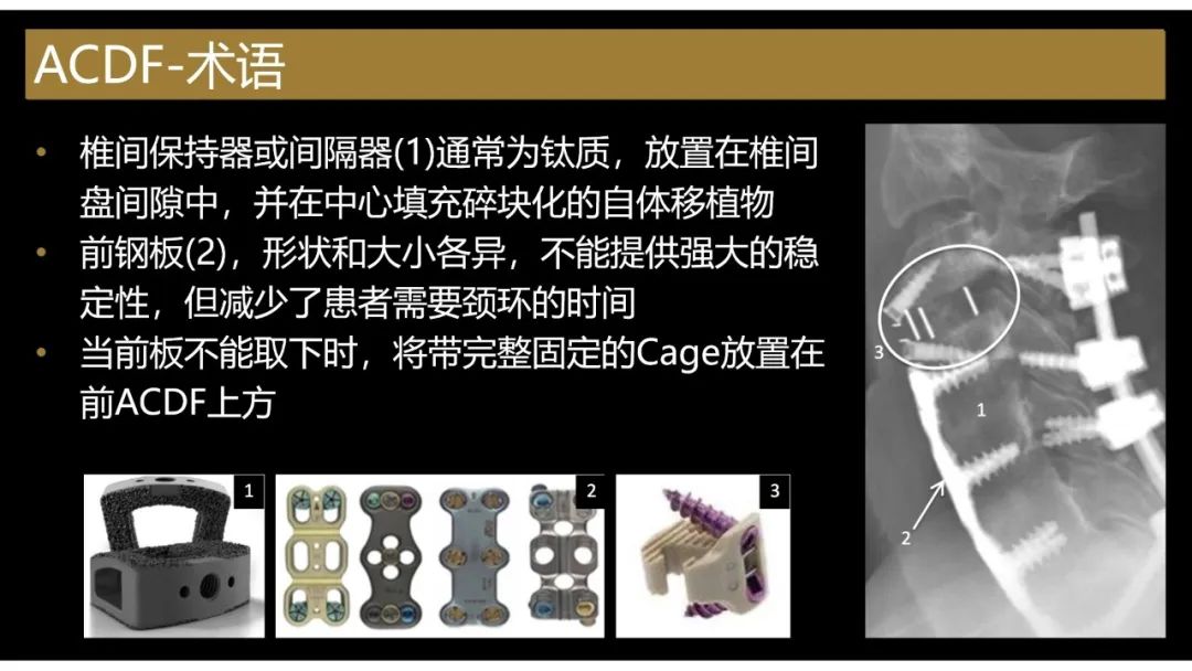 【PPT】评估围手术期脊柱:除了退行性椎间盘疾病和金属植入物的并发症外-15 【PPT】评估围手术期脊柱:除了退行性椎间盘疾病和金属植入物的并发症外-15