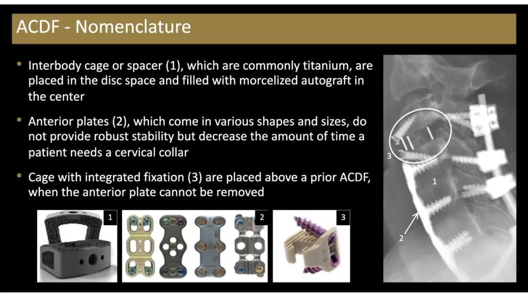 【PPT】评估围手术期脊柱:除了退行性椎间盘疾病和金属植入物的并发症外-16 【PPT】评估围手术期脊柱:除了退行性椎间盘疾病和金属植入物的并发症外-16