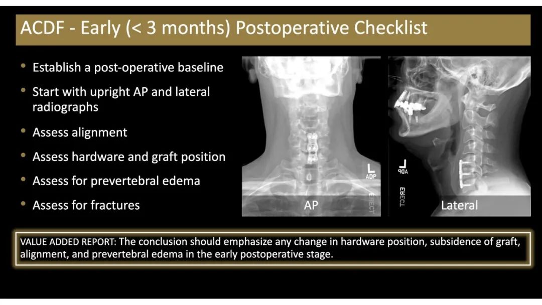 【PPT】评估围手术期脊柱:除了退行性椎间盘疾病和金属植入物的并发症外-20 【PPT】评估围手术期脊柱:除了退行性椎间盘疾病和金属植入物的并发症外-20