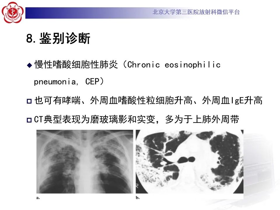 【PPT】嗜酸性肉芽肿性多血管炎-33