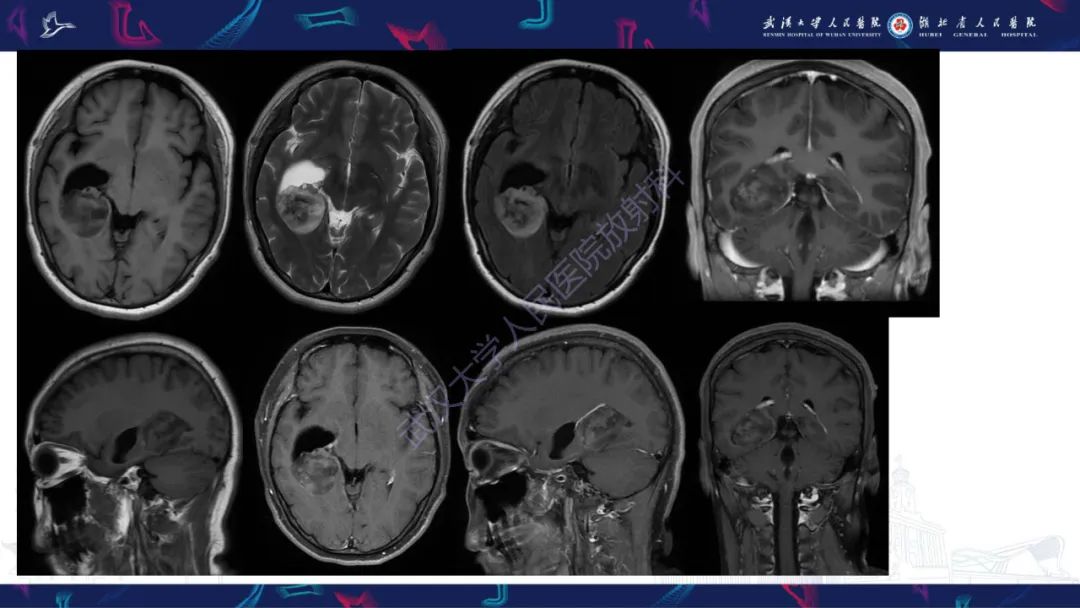 【PPT】侧脑室肿瘤影像诊断-4