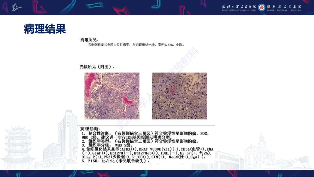 【PPT】侧脑室肿瘤影像诊断-6