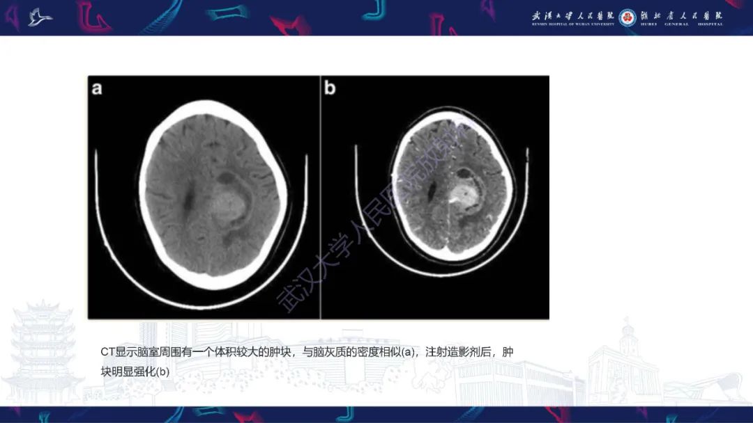 【PPT】侧脑室肿瘤影像诊断-10