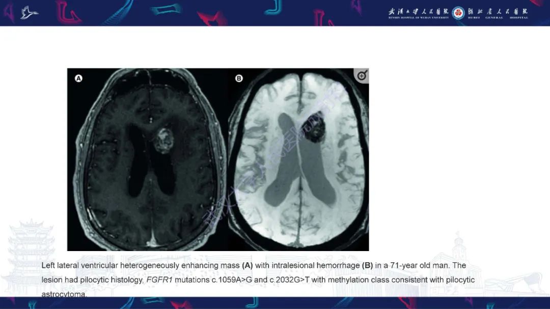 【PPT】侧脑室肿瘤影像诊断-12