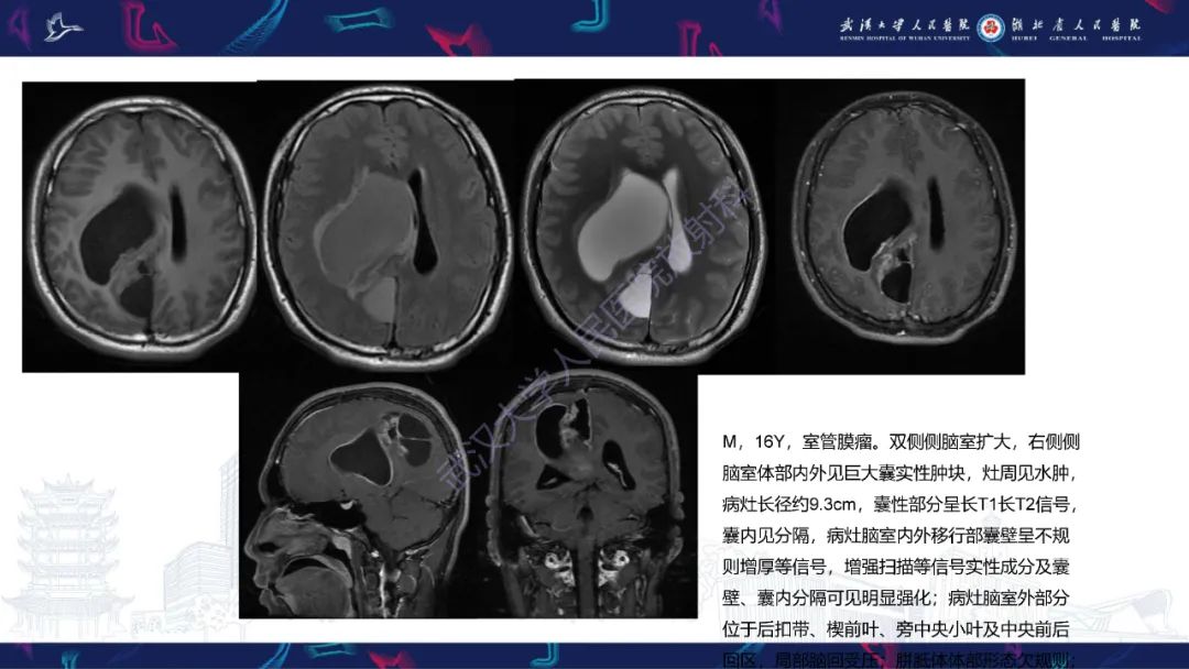 【PPT】侧脑室肿瘤影像诊断-14