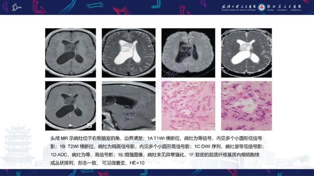 【PPT】侧脑室肿瘤影像诊断-16