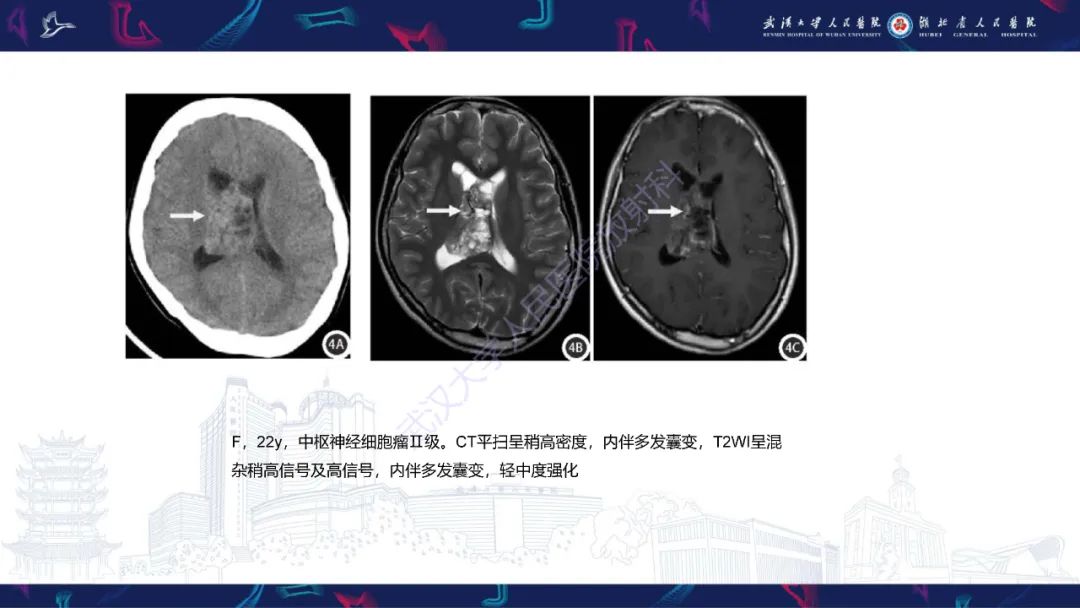 【PPT】侧脑室肿瘤影像诊断-18