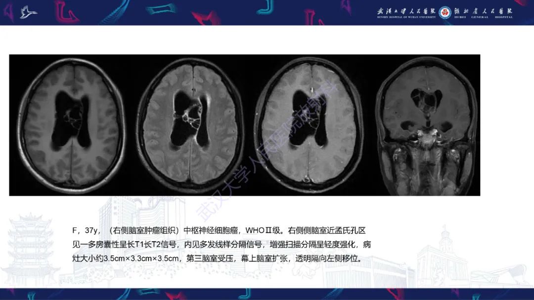 【PPT】侧脑室肿瘤影像诊断-19