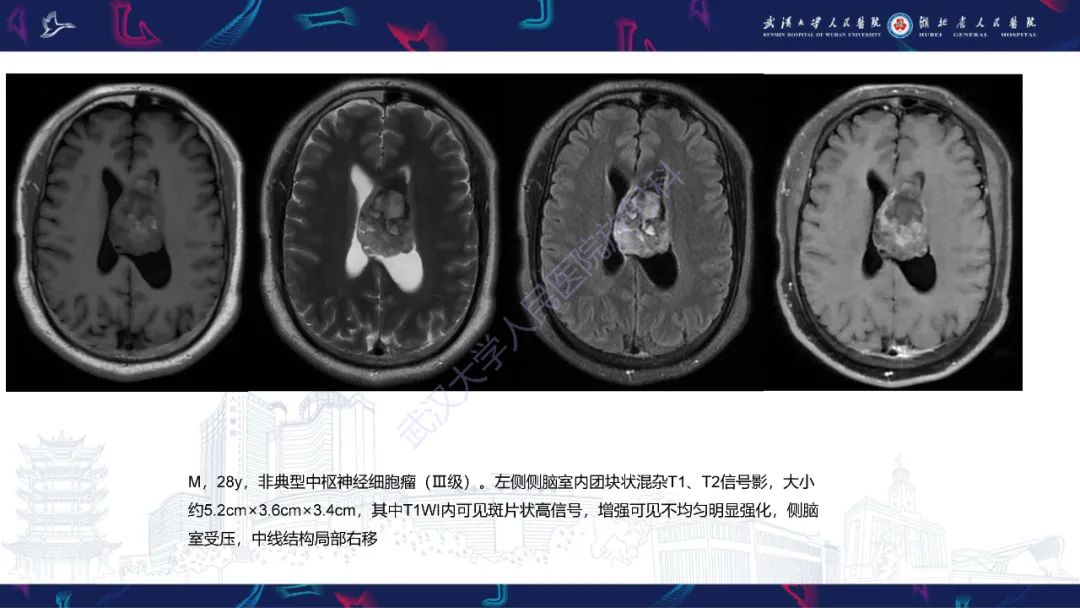 【PPT】侧脑室肿瘤影像诊断-20