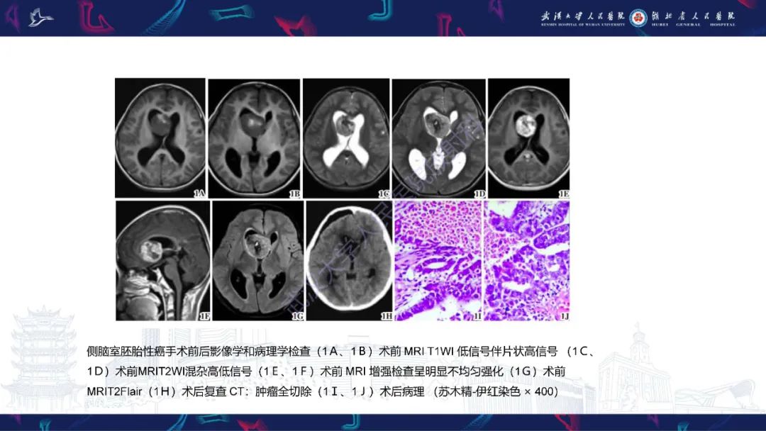 【PPT】侧脑室肿瘤影像诊断-22